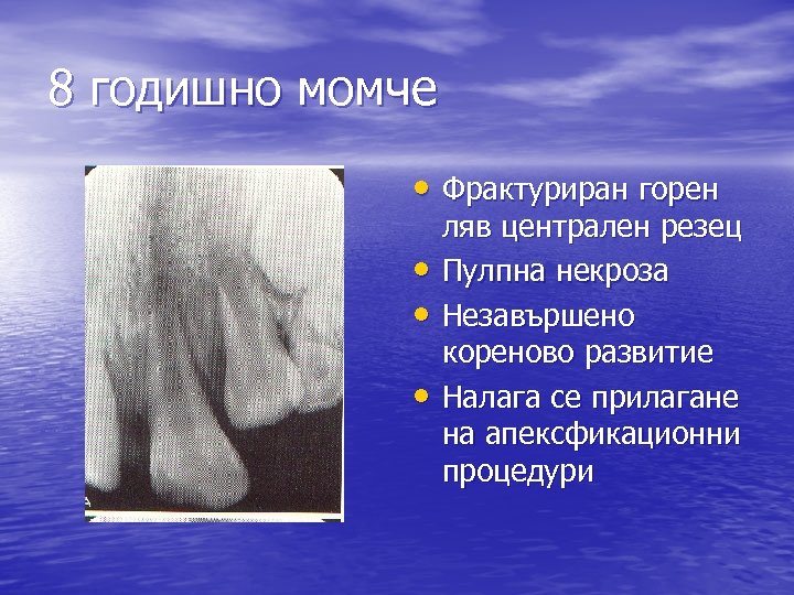 8 годишно момче • Фрактуриран горен • • • ляв централен резец Пулпна некроза