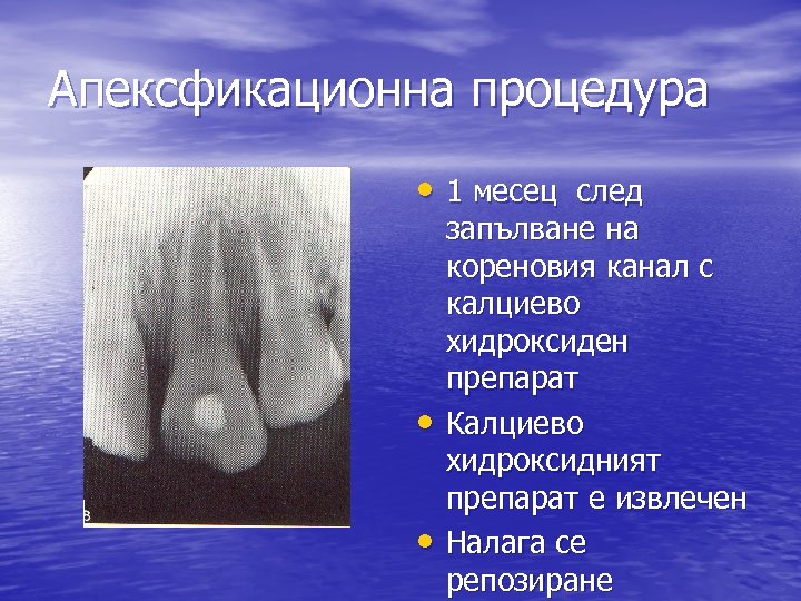 Апексфикационна процедура • 1 месец след • • запълване на кореновия канал с калциево