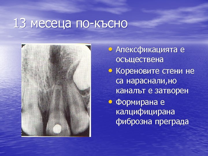 13 месеца по-късно • Апексфикацията е • • осъществена Кореновите стени не са нараснали,
