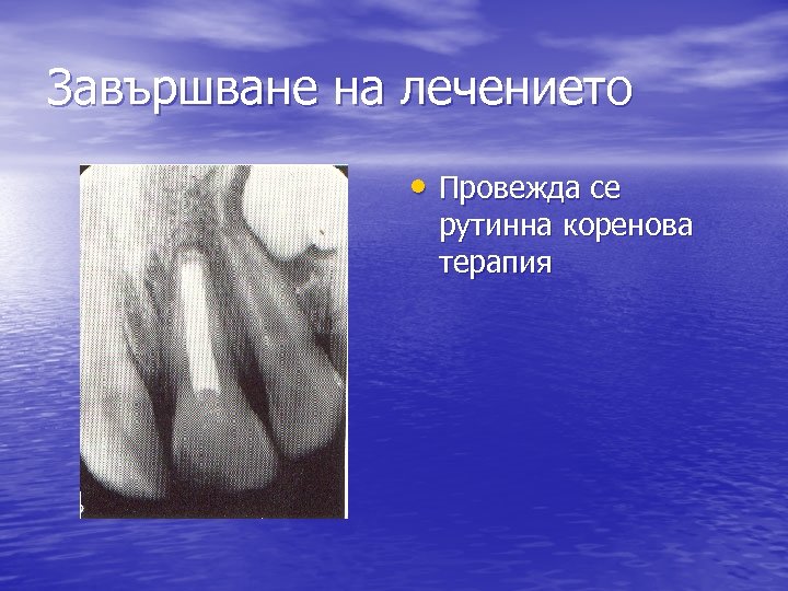 Завършване на лечението • Провежда се рутинна коренова терапия 