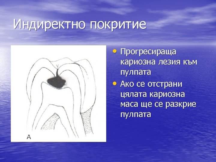 Индиректно покритие • Прогресираща • кариозна лезия към пулпата Ако се отстрани цялата кариозна