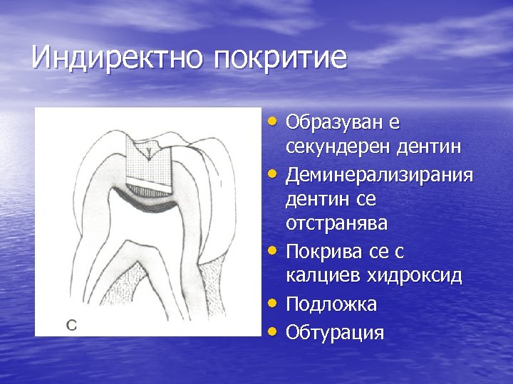 Индиректно покритие • Образуван е • • секундерен дентин Деминерализирания дентин се отстранява Покрива