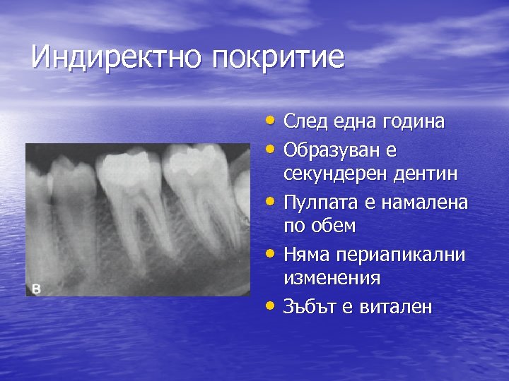 Индиректно покритие • След една година • Образуван е • • • секундерен дентин