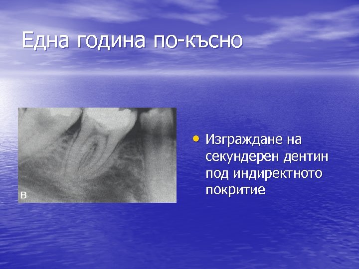 Една година по-късно • Изграждане на секундерен дентин под индиректното покритие 