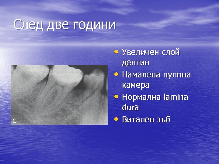 След две години • Увеличен слой • • • дентин Намалена пулпна камера Нормална