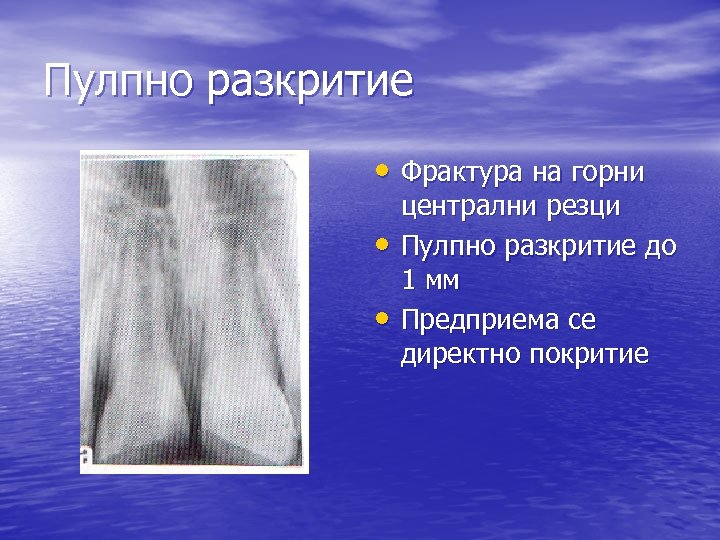 Пулпно разкритие • Фрактура на горни • • централни резци Пулпно разкритие до 1