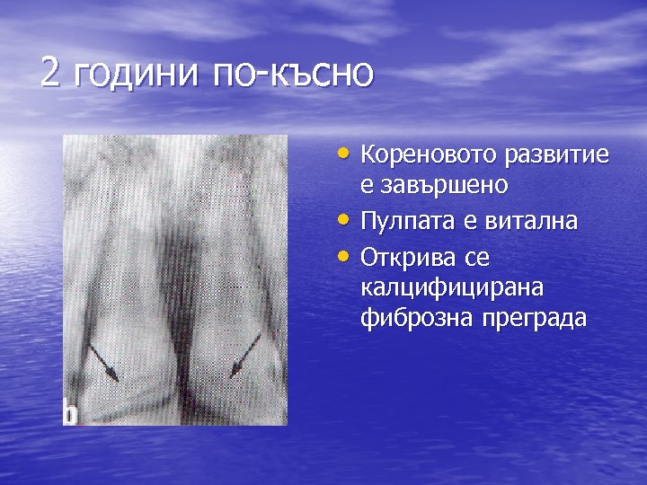 2 години по-късно • Кореновото развитие • • е завършено Пулпата е витална Открива