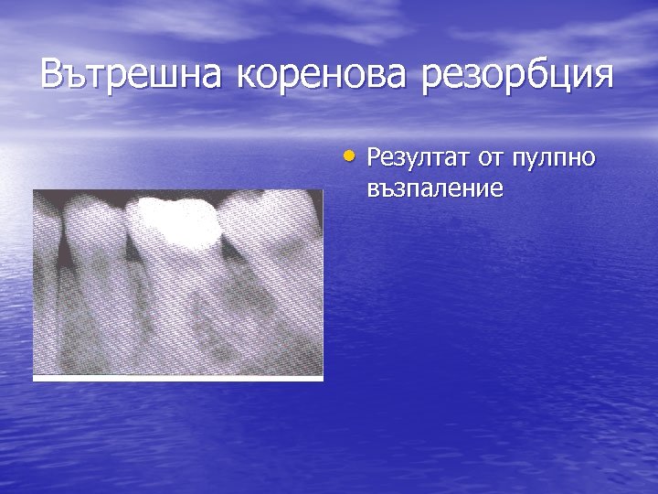 Вътрешна коренова резорбция • Резултат от пулпно възпаление 