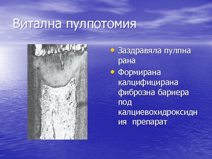 Витална пулпотомия • Заздравяла пулпна • рана Формирана калцифицирана фиброзна бариера под калциевохидроксидн ия
