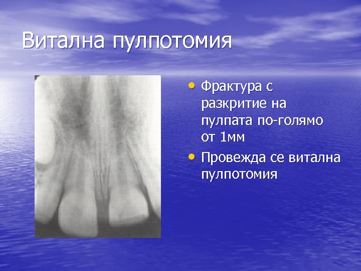 Витална пулпотомия • Фрактура с • разкритие на пулпата по-голямо от 1 мм Провежда