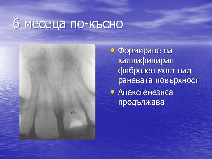 6 месеца по-късно • Формиране на • калцифициран фиброзен мост над раневата повърхност Апексгенезиса