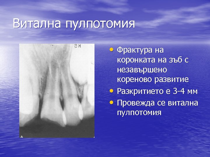 Витална пулпотомия • Фрактура на • • коронката на зъб с незавършено кореново развитие