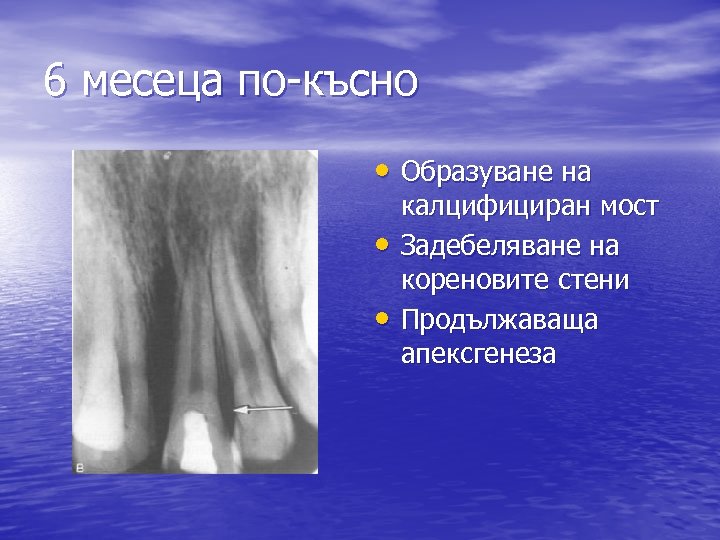 6 месеца по-късно • Образуване на • • калцифициран мост Задебеляване на кореновите стени