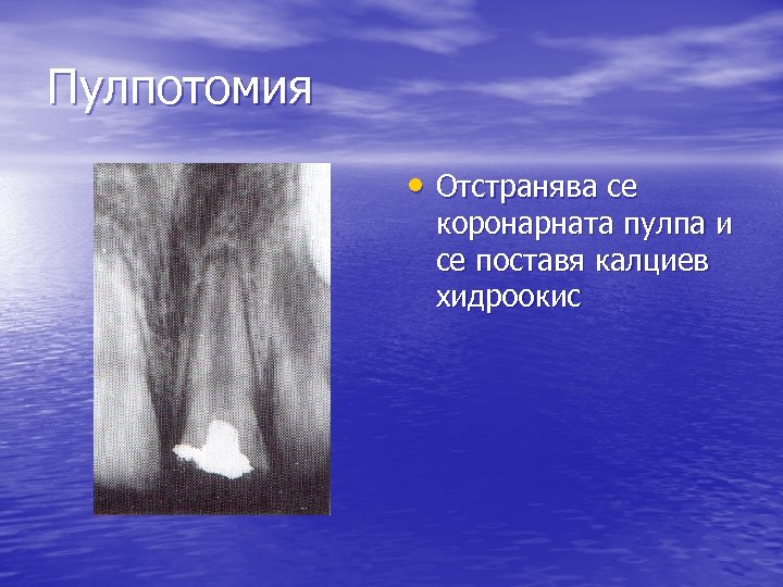 Пулпотомия • Отстранява се коронарната пулпа и се поставя калциев хидроокис 