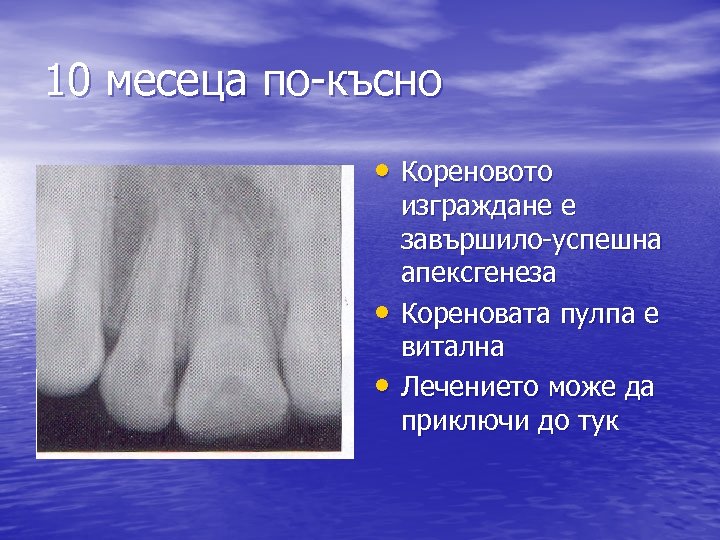 10 месеца по-късно • Кореновото • • изграждане е завършило-успешна апексгенеза Кореновата пулпа е