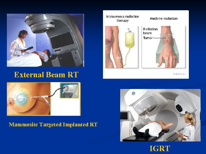 External Beam RT Mammosite Targeted Implanted RT IGRT 