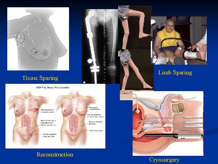 Tissue Sparing Reconstruction Limb Sparing Cryosurgery 