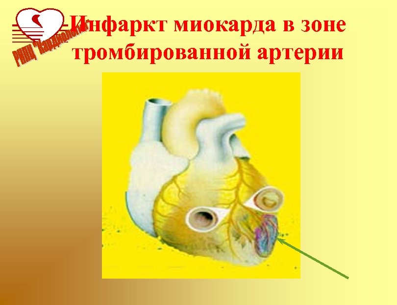 Инфаркт миокарда в зоне тромбированной артерии 