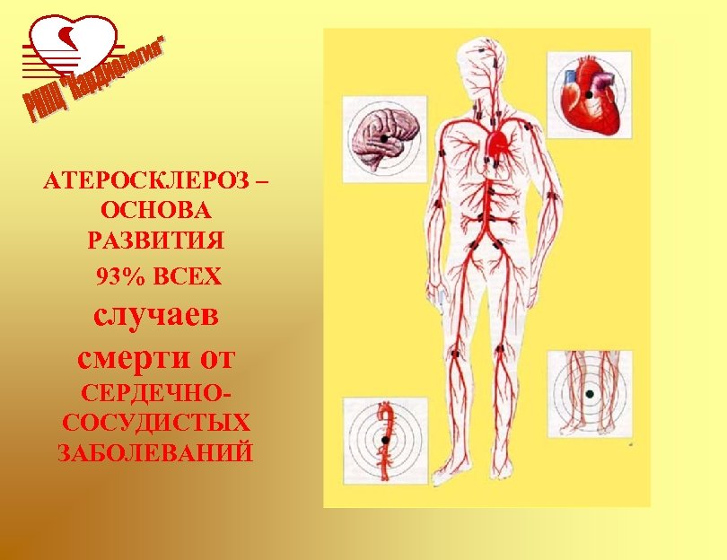 АТЕРОСКЛЕРОЗ – ОСНОВА РАЗВИТИЯ 93% ВСЕХ случаев смерти от СЕРДЕЧНОСОСУДИСТЫХ ЗАБОЛЕВАНИЙ 