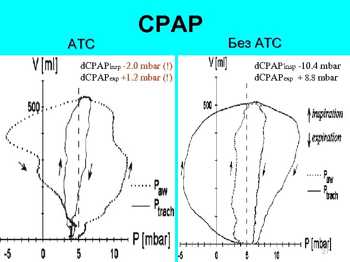 ATС СPAP d. CPAPinsp -2. 0 mbar (!) d. CPAPexp +1. 2 mbar (!)