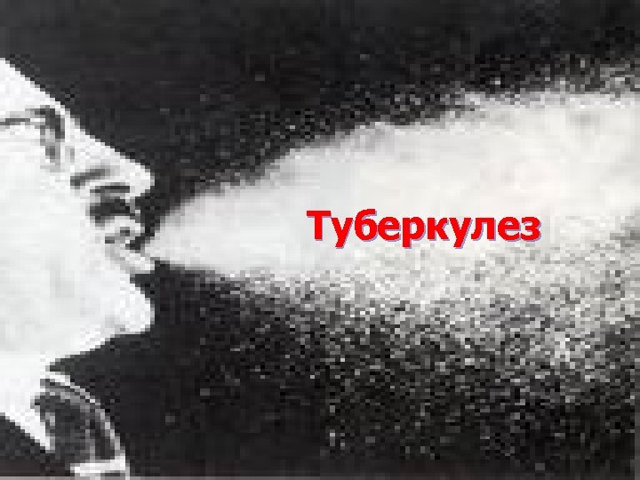 Туберкулез 