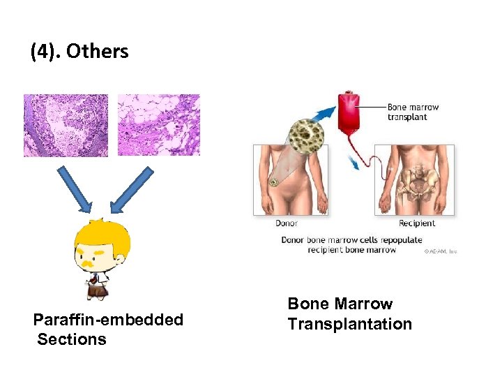 (4). Others Paraffin-embedded Sections Bone Marrow Transplantation 