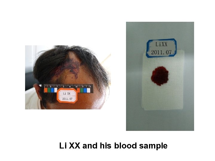 Li XX and his blood sample 