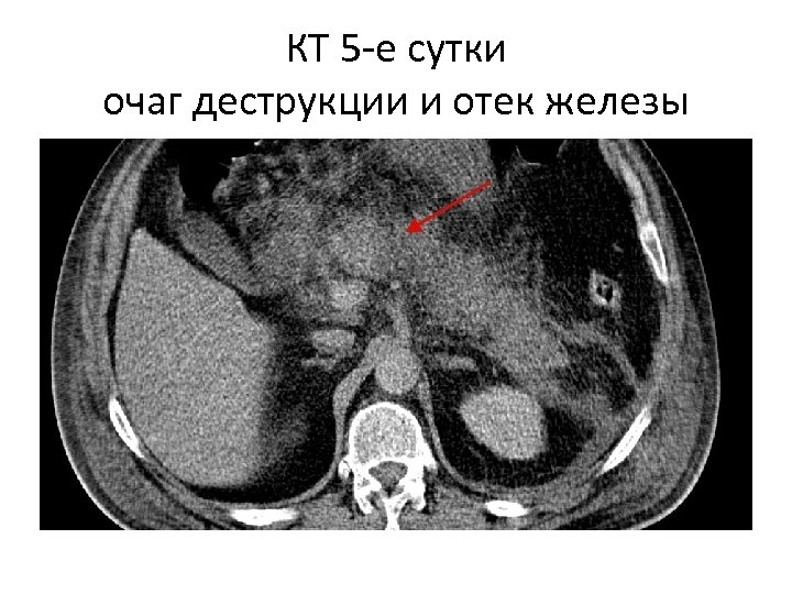 КТ 5 -е сутки очаг деструкции и отек железы 