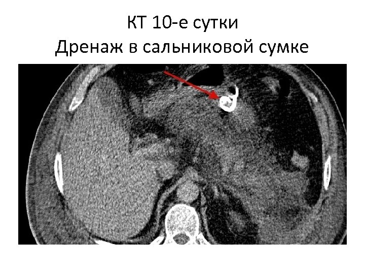 КТ 10 -е сутки Дренаж в сальниковой сумке 