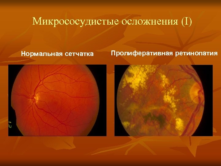 Микрососудистые осложнения (I) Нормальная сетчатка Пролиферативная ретинопатия 