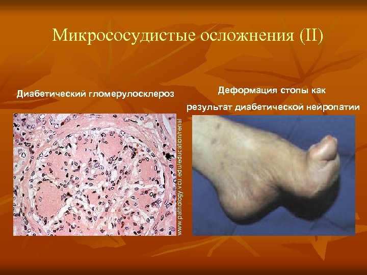 Микрососудистые осложнения (II) Деформация стопы как Диабетический гломерулосклероз www. pathology. vcu. edu/education/renal результат диабетической