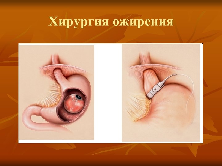 Хирургия ожирения 