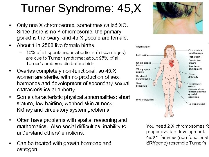 Turner Syndrome: 45, X • • Only one X chromosome, sometimes called XO. Since