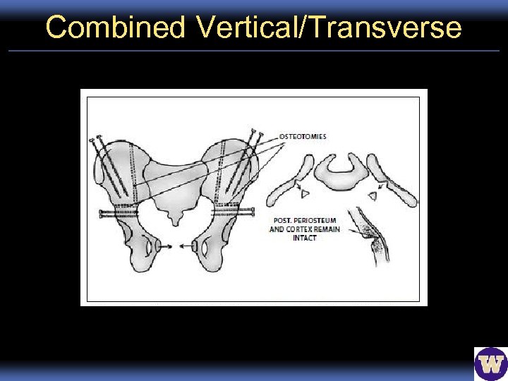 Combined Vertical/Transverse 