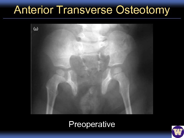 Anterior Transverse Osteotomy Preoperative 