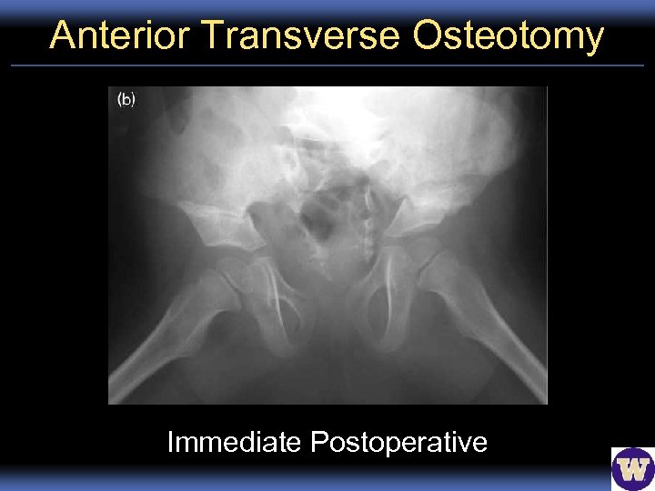 Anterior Transverse Osteotomy Immediate Postoperative 