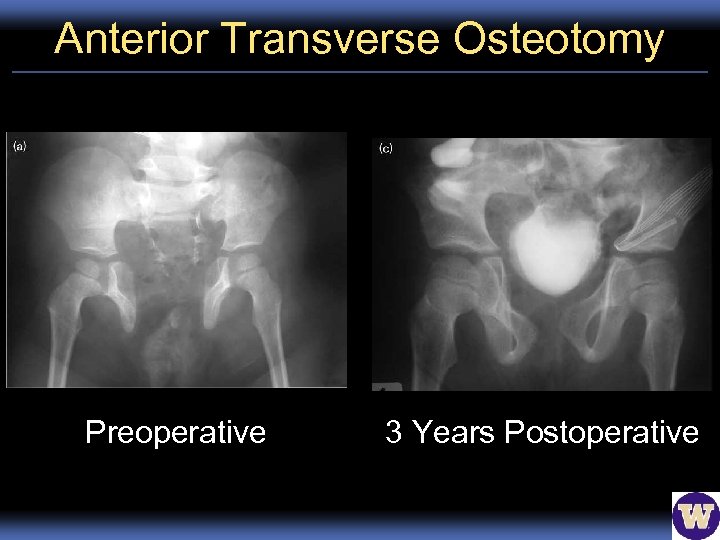 Anterior Transverse Osteotomy Preoperative 3 Years Postoperative 