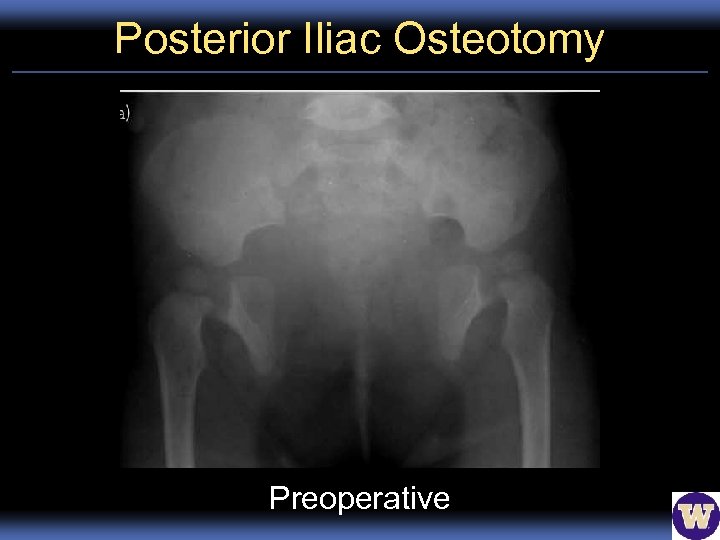 Posterior Iliac Osteotomy Preoperative 