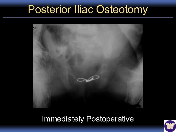 Posterior Iliac Osteotomy Immediately Postoperative 