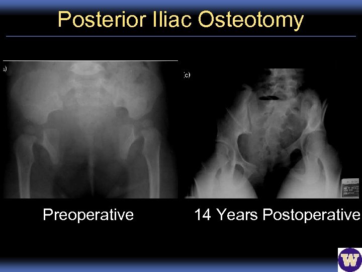 Posterior Iliac Osteotomy Preoperative 14 Years Postoperative 