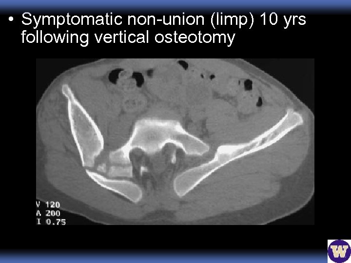  • Symptomatic non-union (limp) 10 yrs following vertical osteotomy 