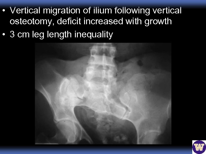  • Vertical migration of ilium following vertical osteotomy, deficit increased with growth •