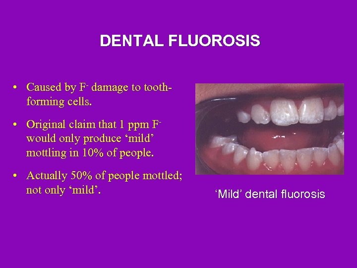 DENTAL FLUOROSIS • Caused by F- damage to toothforming cells. • Original claim that