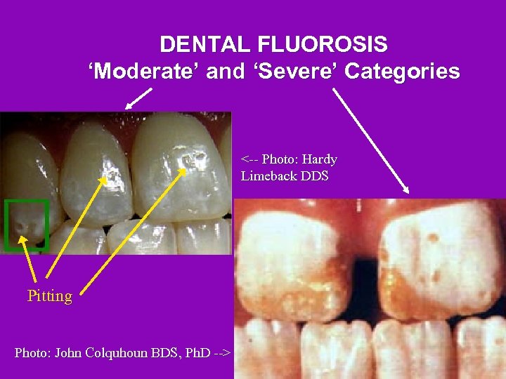 DENTAL FLUOROSIS ‘Moderate’ and ‘Severe’ Categories <-- Photo: Hardy Limeback DDS Pitting Photo: John