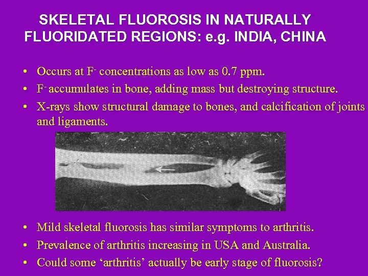 SKELETAL FLUOROSIS IN NATURALLY FLUORIDATED REGIONS: e. g. INDIA, CHINA • • • Occurs