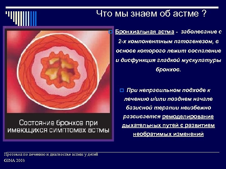 Что мы знаем об астме ? o Бронхиальная астма - заболевание с 2 -х