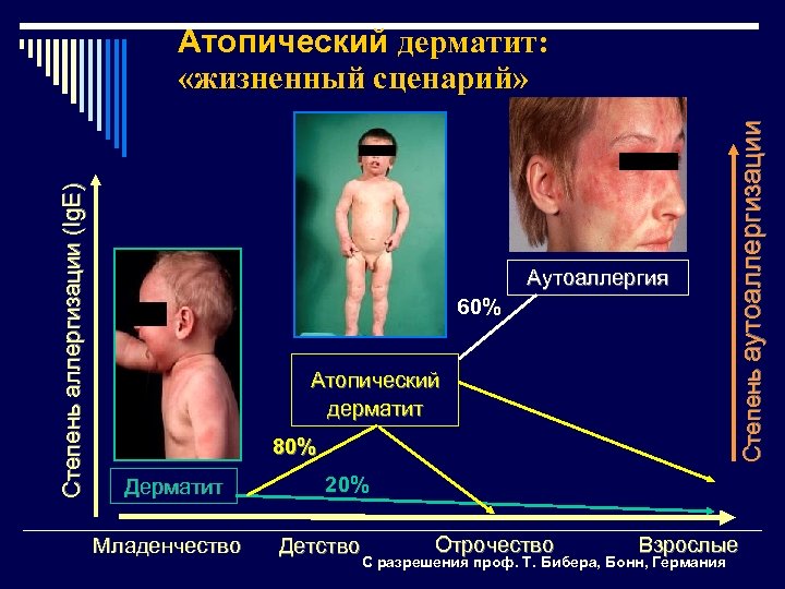 Аутоаллергия 60% Атопический дерматит 80% Дерматит Младенчество Степень аутоаллергизации Степень аллергизации (Ig. E) Атопический