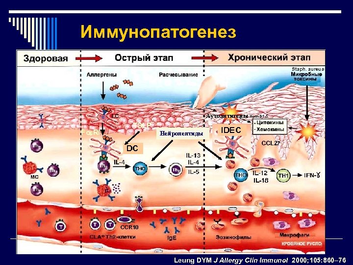 Иммунопатогенез Staph. aureus Аутоантигены Hom S 1 -5 Fce. RI TSLP Нейропептиды DC IDEC