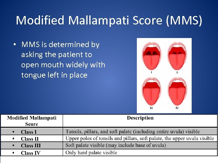 Modified Mallampati Score (MMS) • MMS is determined by asking the patient to open