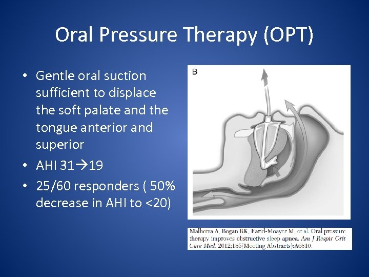 Oral Pressure Therapy (OPT) • Gentle oral suction sufficient to displace the soft palate